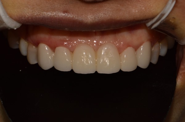 앞니 크라운 재치료 & 잇몸성형 _건강하게 . 예뻐지는 방법 관련 이미지 9