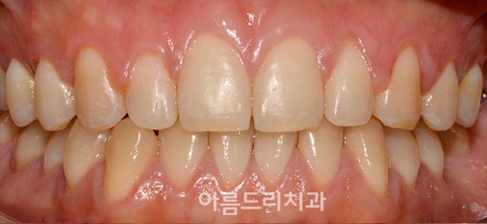 벌어진앞니부분교정 짧은기간 치아교정 관련 이미지 8