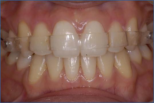 교정 완료_유지 장치 어떤 거 해야 해? 관련 이미지 6