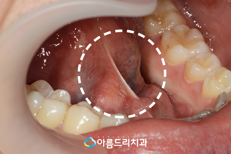 설소대단축증 - 단설소대증의 치료과정 관련 이미지 4