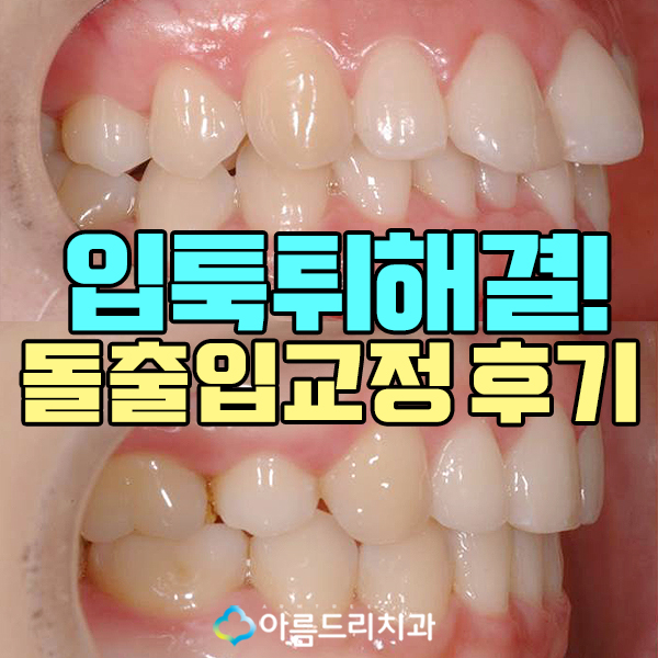 돌출입교정후기 급속으로 입툭튀 안녕 관련 이미지 1