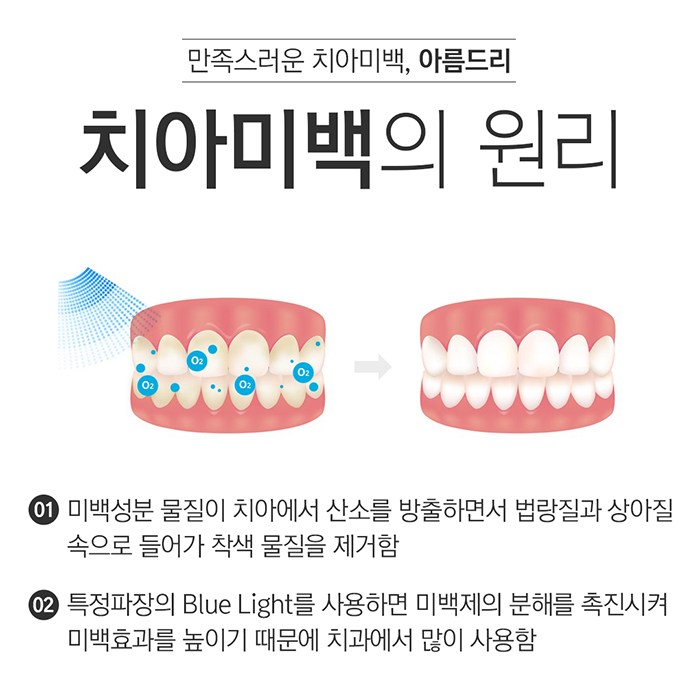 이빨미백 치과치아미백 결과의 차이 관련 이미지 4