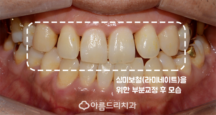 라미네이트교정 최소삭제 치아성형 후기 관련 이미지 6