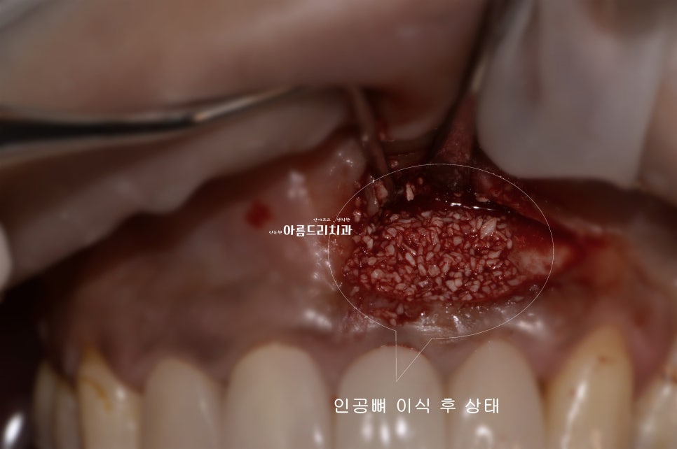 뽑지 않고 자가치아를 살려주세요_치아 뿌리수술_치근단절제술+뼈이식 관련 이미지 4