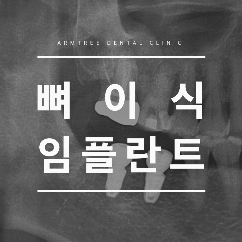 뼈이식임플란트 꼼꼼한 아름드리치과로 관련 이미지 1