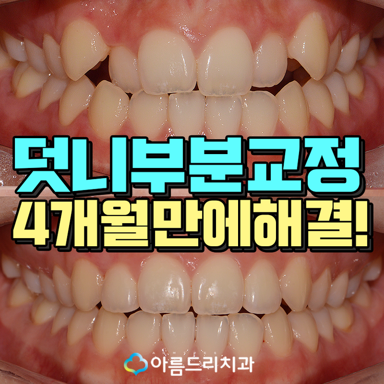 덧니교정 빠르게 부분만 관련 이미지 1