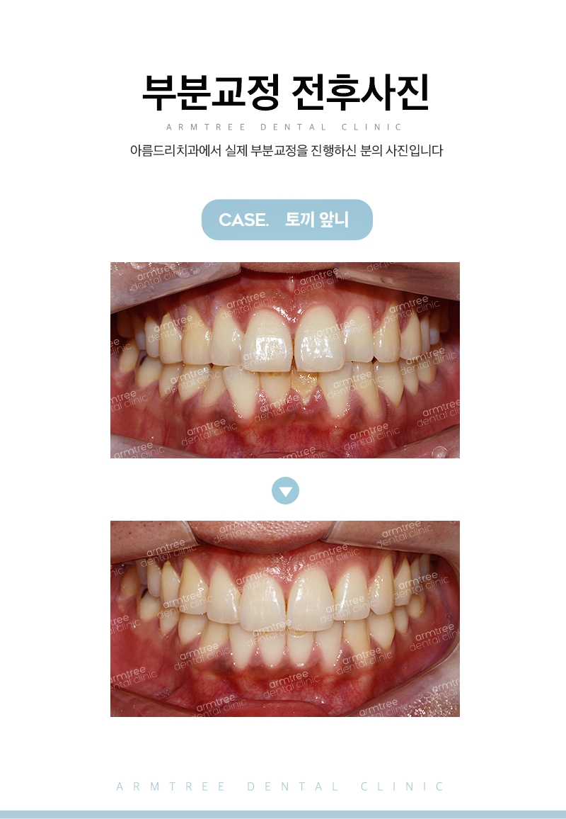 돌출앞니부분교정 빠르게 신논현역 아름드리치과 관련 이미지 11