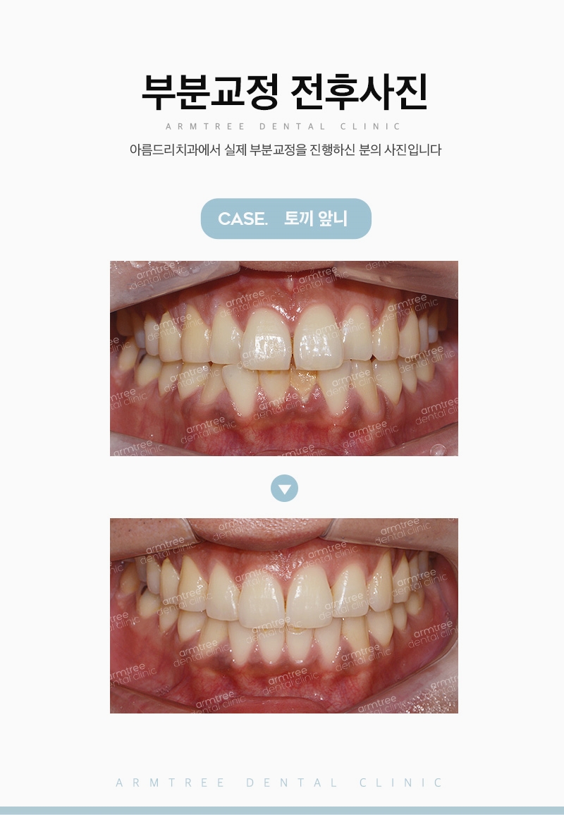벌어진앞니부분교정 후기 신논현역 아름드리치과는 관련 이미지 11