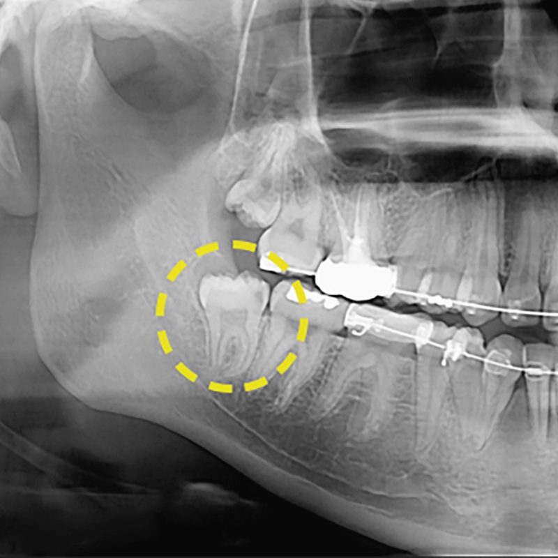 매복사랑니 발치후기 통증없는 아름드리치과 관련 이미지 1