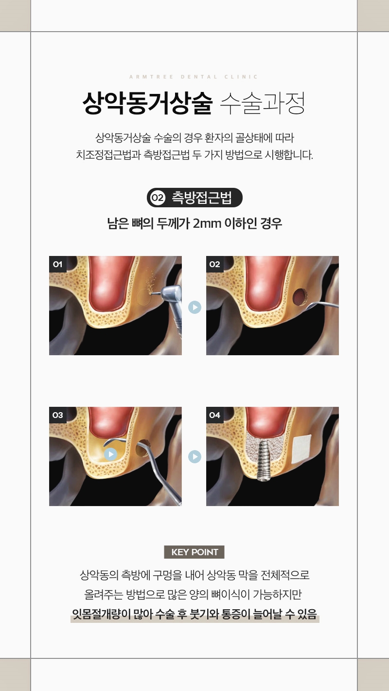 신논현역치과 상악동거상술과 임플란트는 아름드리치과에서 관련 이미지 5
