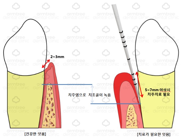[치주 질환-1] 양치할 때마다 피가 난다?(아름드리 치아상식) 관련 이미지 5