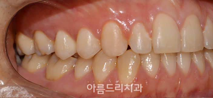 벌어진앞니부분교정 짧은기간 치아교정 관련 이미지 9