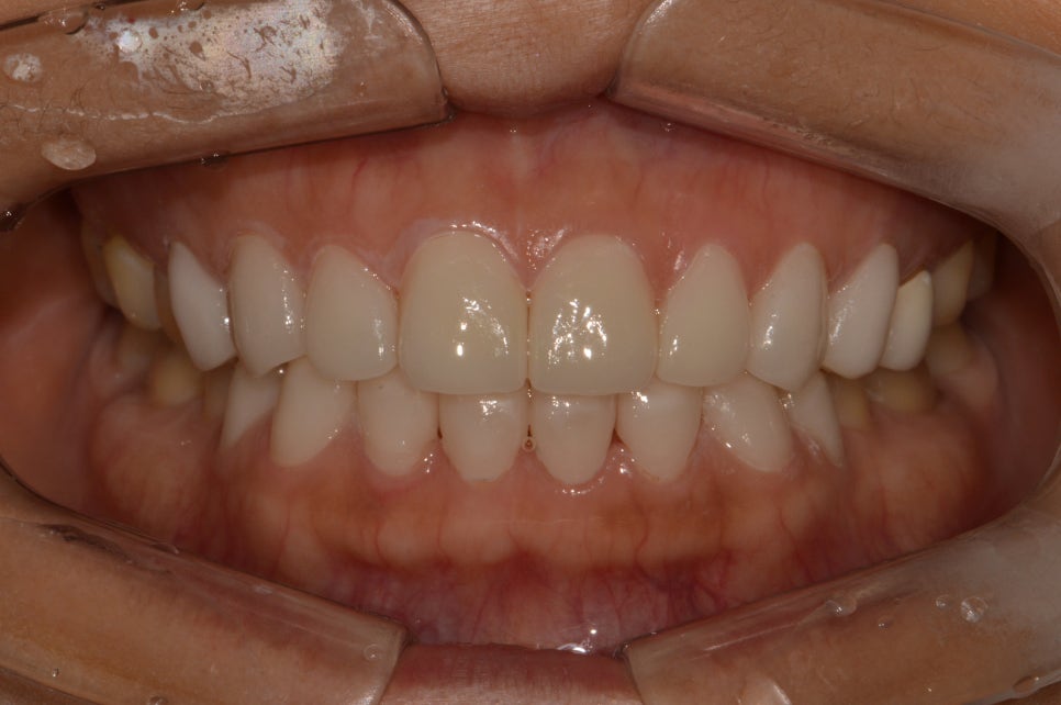 [신논현 치과] 3D 구강 스캐너_정확하게 본뜨기 관련 이미지 11