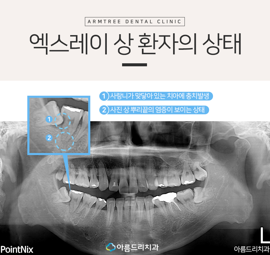 치아재식술 자연치아살리기 관련 이미지 3