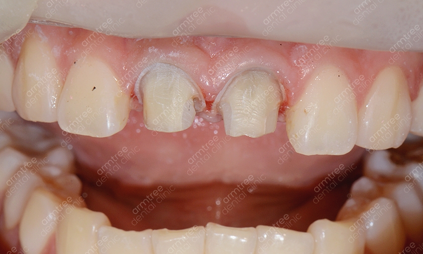 실활치미백 앞니변색 걱정없는 아름드리치과 관련 이미지 5