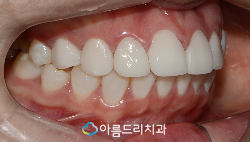 라미네이트부작용 걱정은노 관련 이미지 10