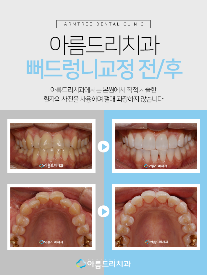 뻐드렁니 교정부분으로 빠르게 관련 이미지 7
