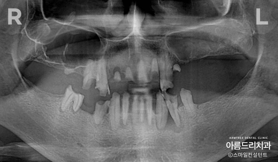 전체임플란트 전악임플란트 전후 아름드리치과 진료일기 관련 이미지 1