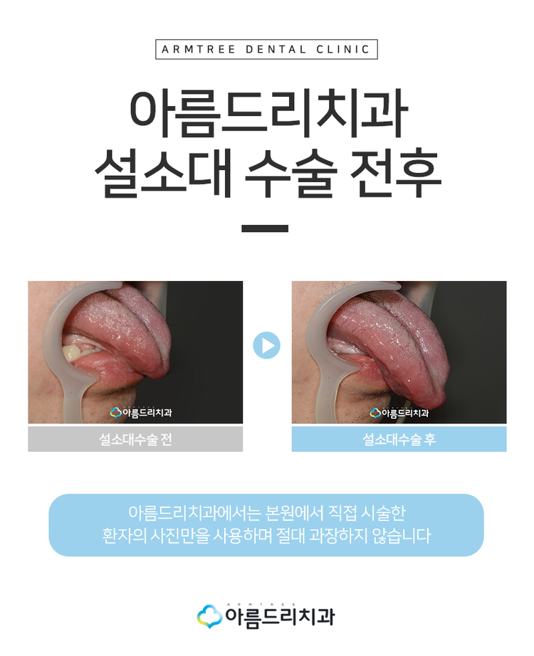설소대수술 단축증후기 아름드리 관련 이미지 9