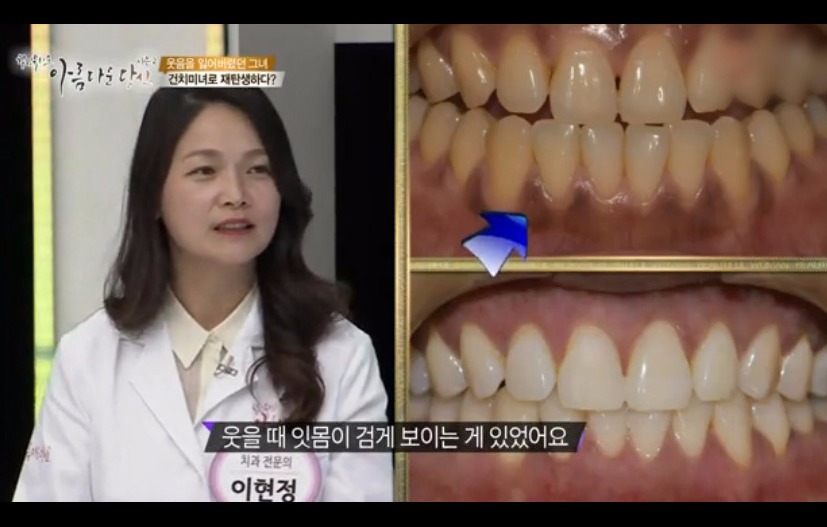이현정원장의 아름다운 당신 시즌 2 (4회 김양경 도전자) 잇몸미백과 치아미백 관련 이미지 4