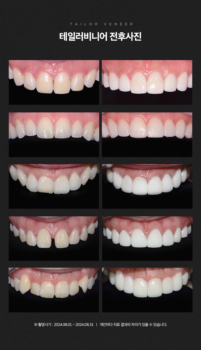 테일러비니어 미리 시착이 가능한 무삭제라미네이트는 관련 이미지 5