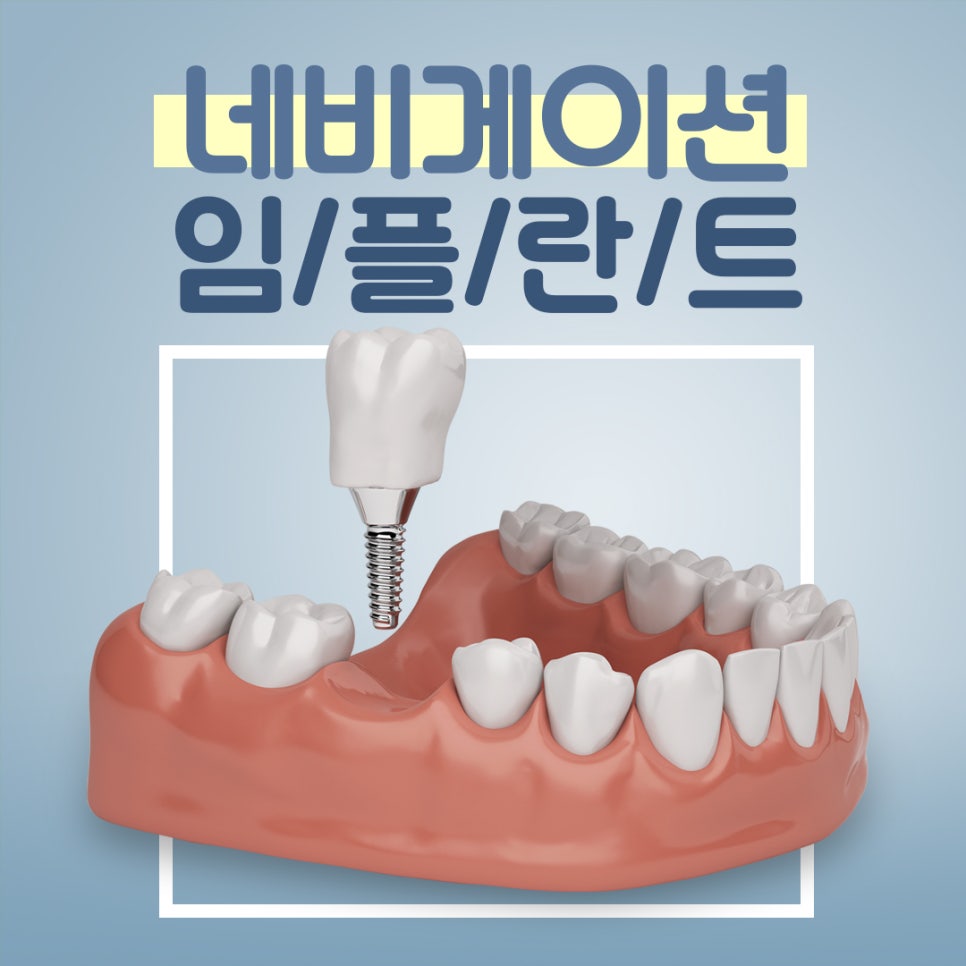 컴퓨터분석 디지털임플란트 어떨까? 관련 이미지 1
