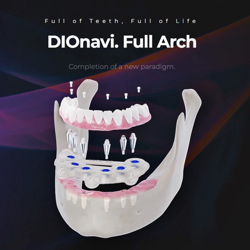 신논현역 전체임플란트는 풀아치임플란트로 관련 이미지 1