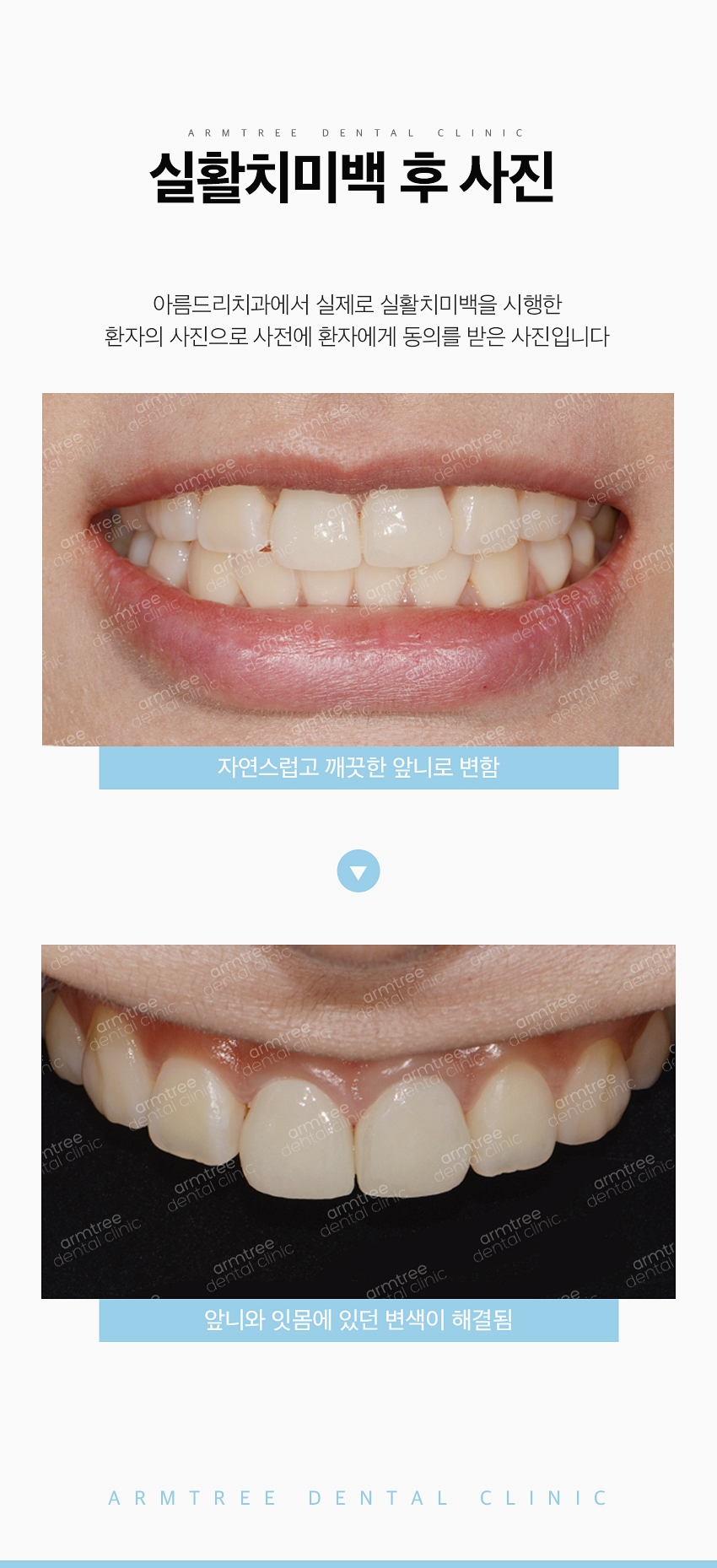 실활치미백 앞니변색 걱정NO! 신논현역 아름드리치과 관련 이미지 10