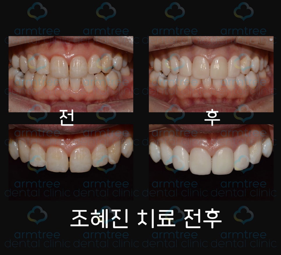 이현정 원장의 아름다운 당신 시즌 1 (9회 조혜진 도전자) 치아성형, 라미네이트, 치아미백, 화이트랩스 관련 이미지 7