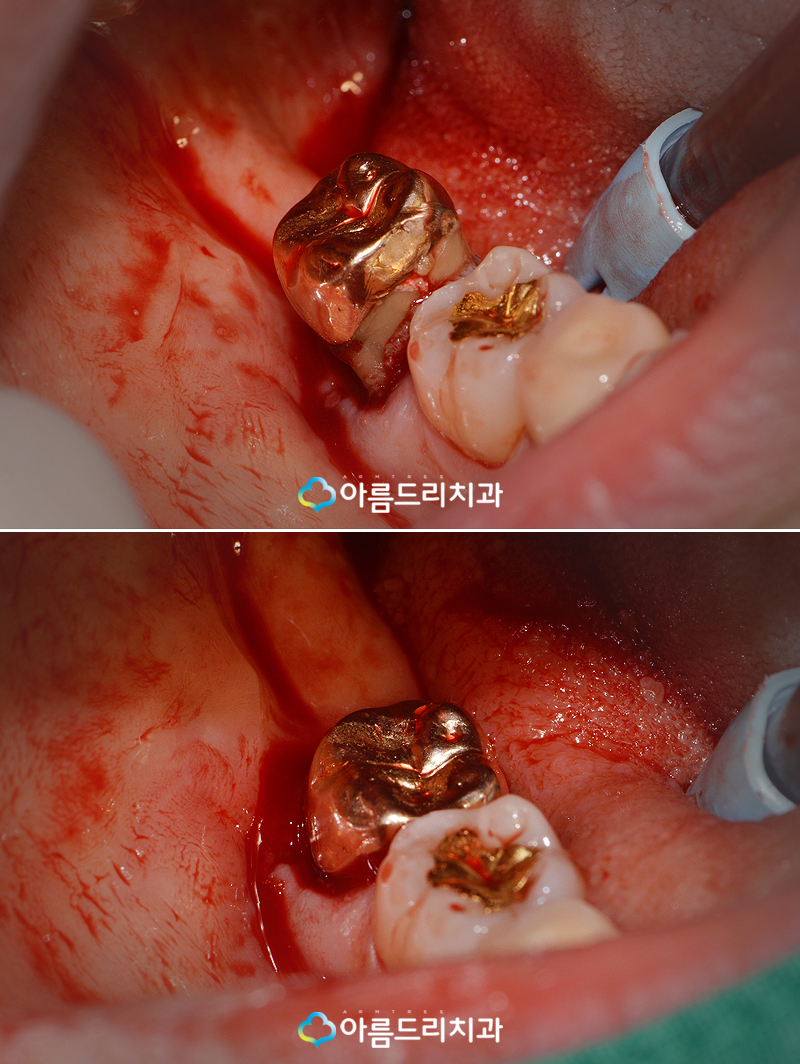 치아재식술 자연치아 살리기 후기 관련 이미지 8