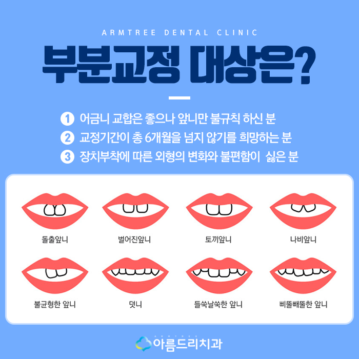 토끼앞니교정 앞니덧니 정답은? 관련 이미지 2