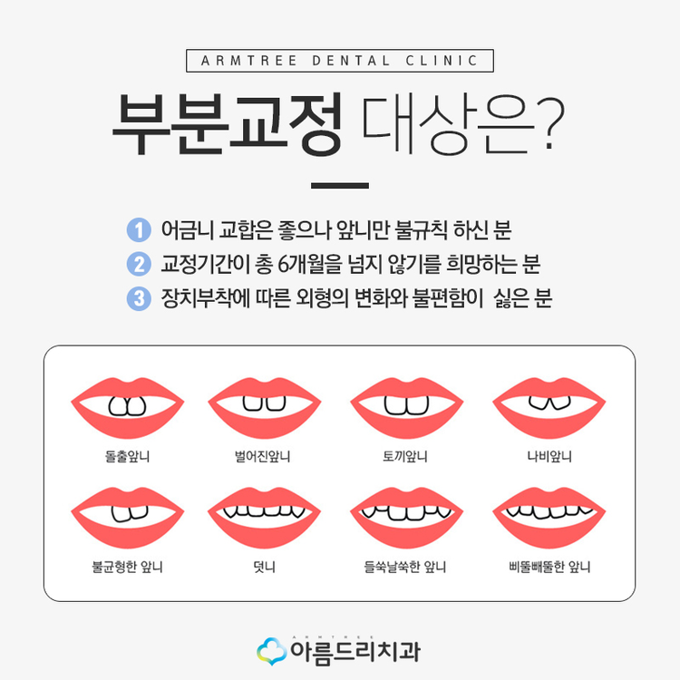 뻐드렁니 교정부분으로 빠르게 관련 이미지 4