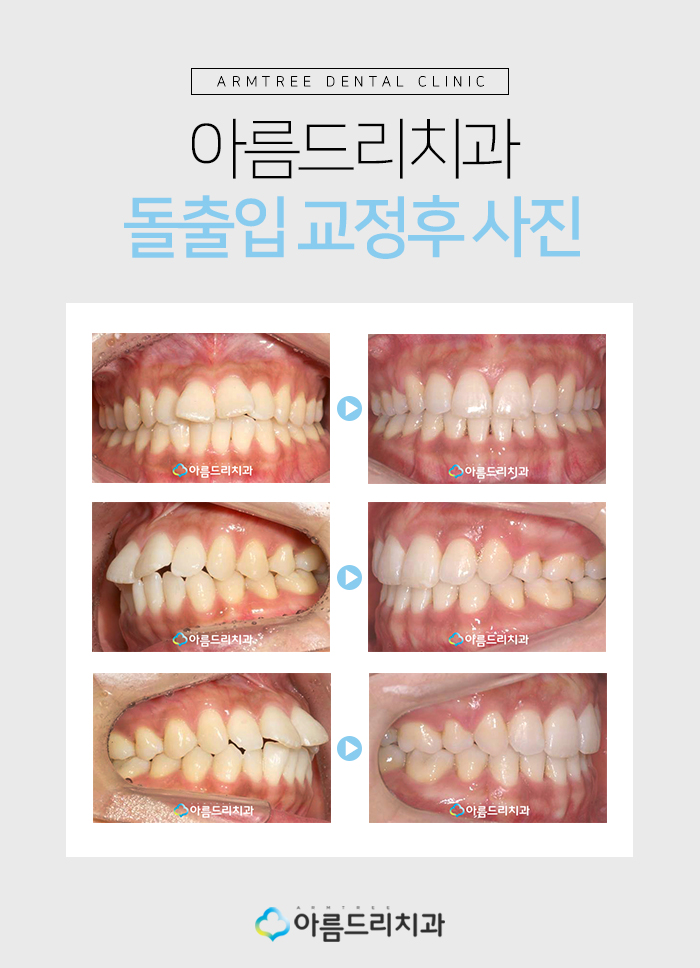 치아교정돌출입 교정후기가 중요햇 관련 이미지 8