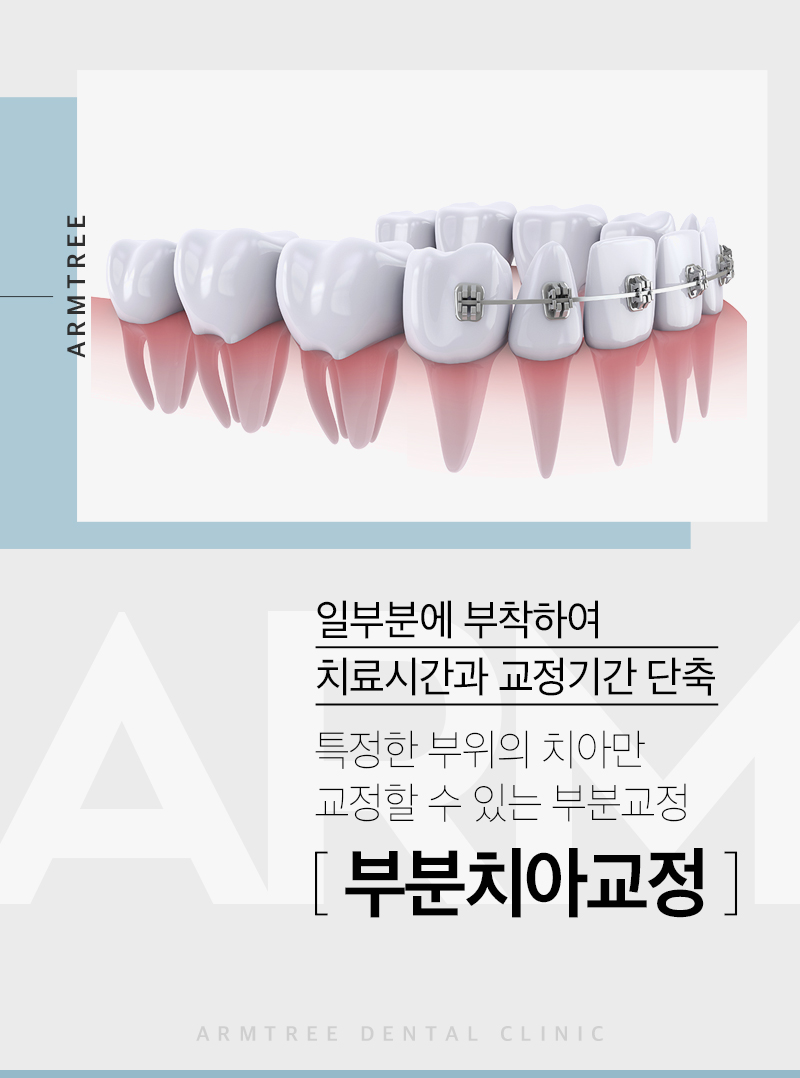 앞니부분교정 꼼꼼하고 예리하게 관련 이미지 4