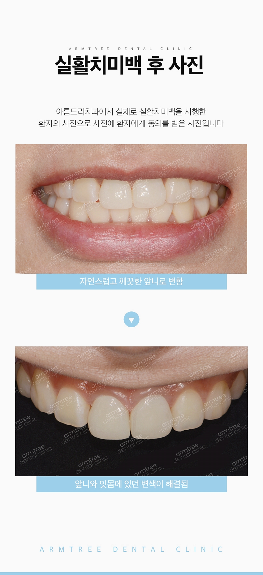 실활치미백 앞니변색 걱정없는 아름드리치과 관련 이미지 10