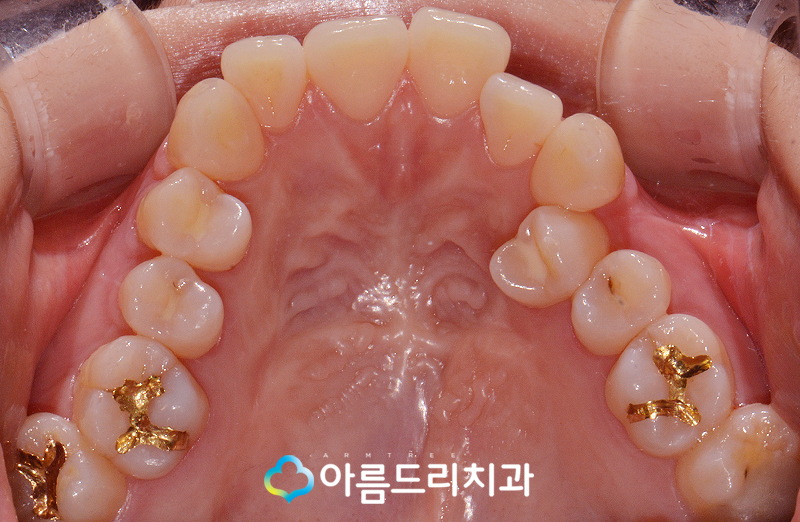 치아부정교합교정 악궁확장장치 후기는? 관련 이미지 5