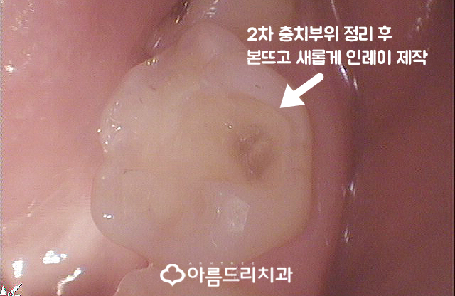 금니 2차충치 생기는 이유와 치료 관련 이미지 7