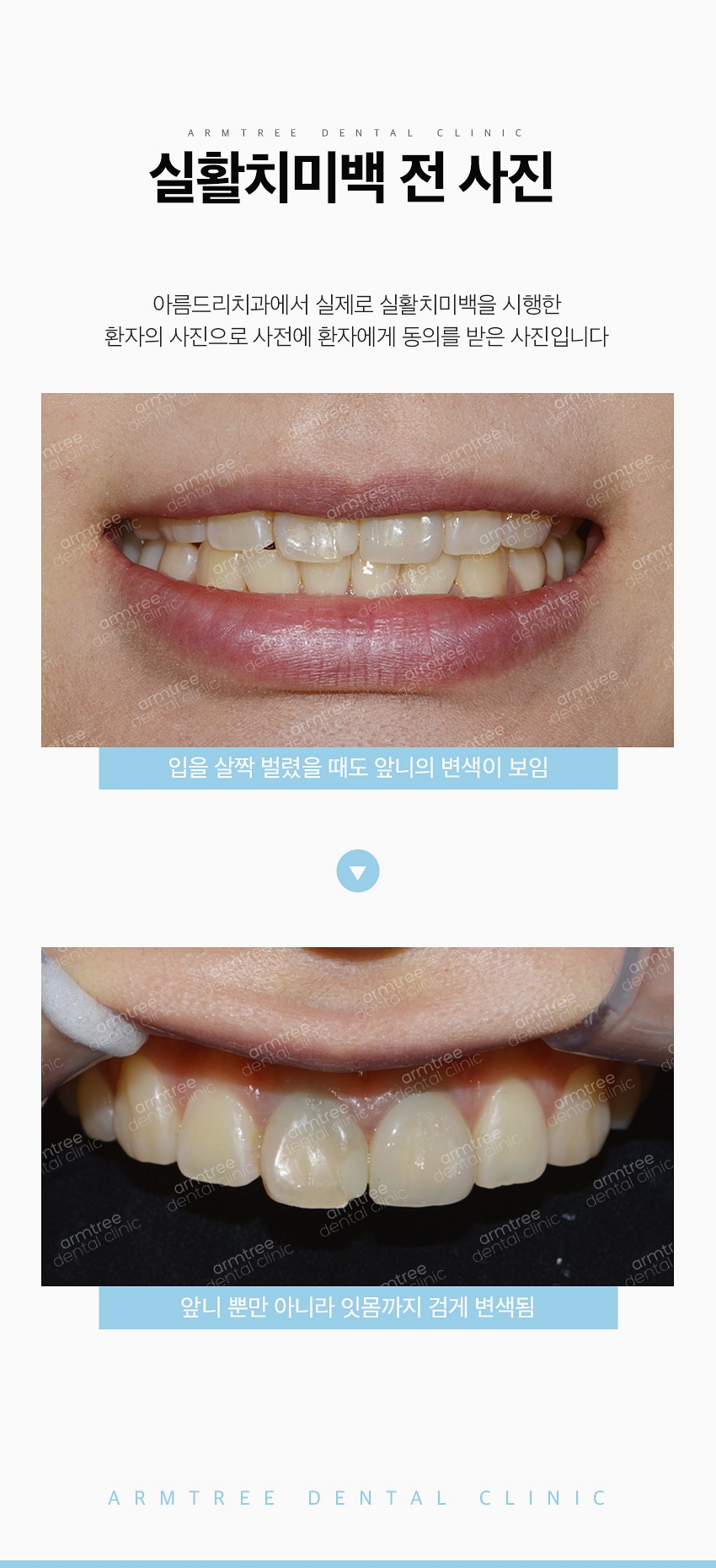 실활치미백 앞니변색 걱정NO! 신논현역 아름드리치과 관련 이미지 2