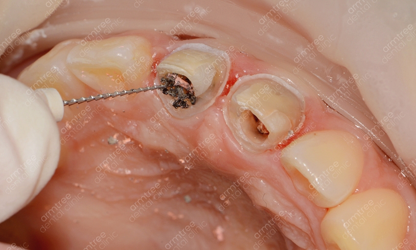 실활치미백 앞니변색 걱정없는 아름드리치과 관련 이미지 6