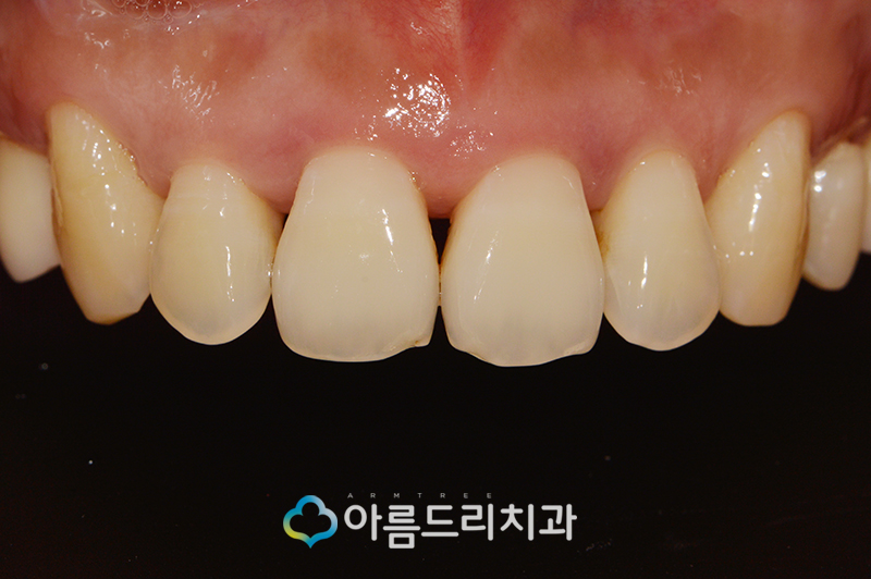 앞니 블랙트라이앵글 치아 이성형으로 해결 관련 이미지 7