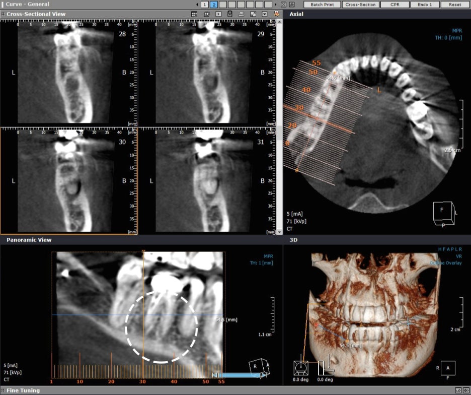 잇몸고름주머니치료 염증제거 아름드리치과 관련 이미지 4