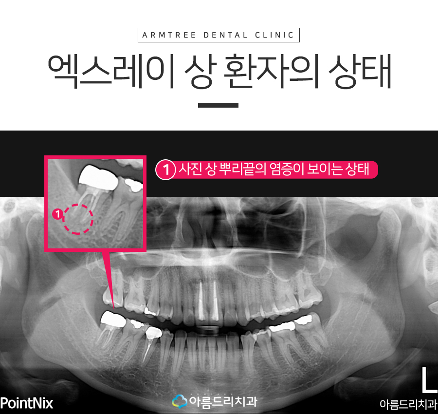 치아재식술 자연치아 살리기 후기 관련 이미지 4