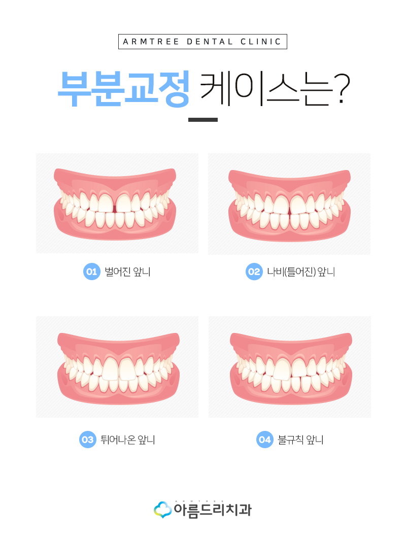 나비치아 교정 앞니 부분교정 후기 관련 이미지 7