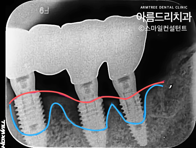 당뇨임플란트 치과 진료일기 관련 이미지 12
