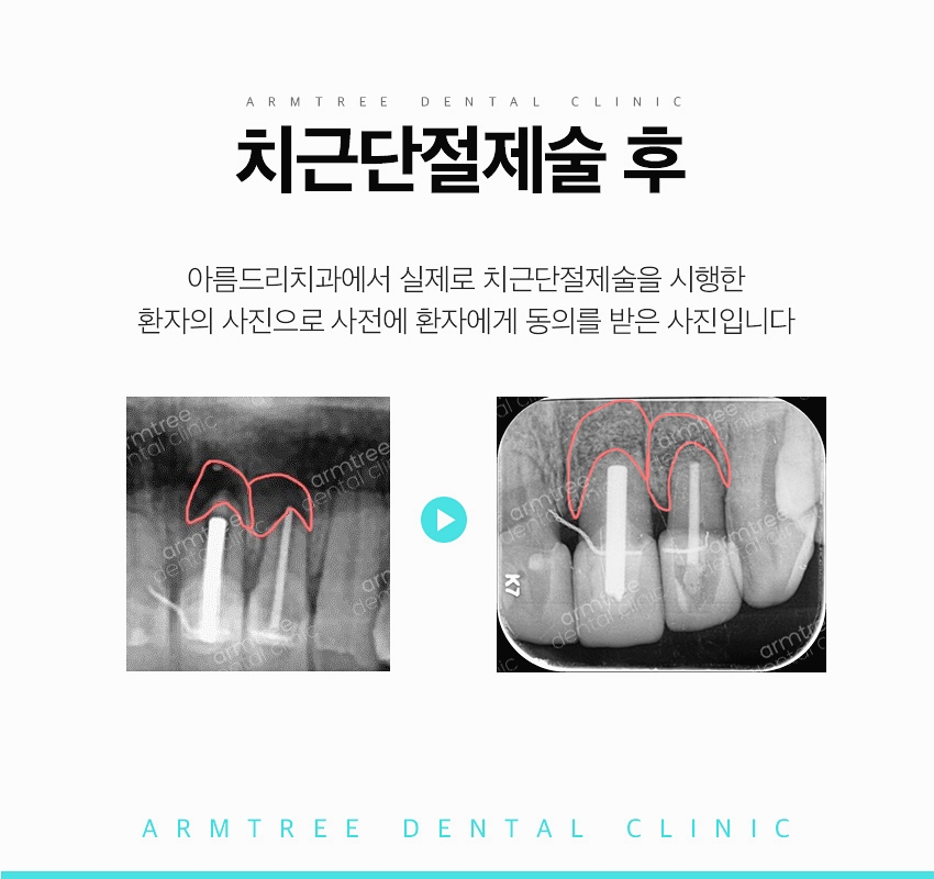 치근단절제술 염증 신뢰있는 후기 아름드리치과 관련 이미지 10