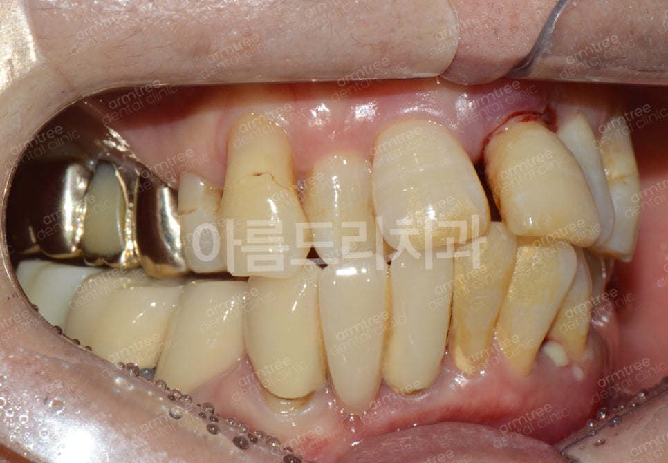 임플란트가 무조건 최선은 아니다! 아름드리치과 진료일기 관련 이미지 6
