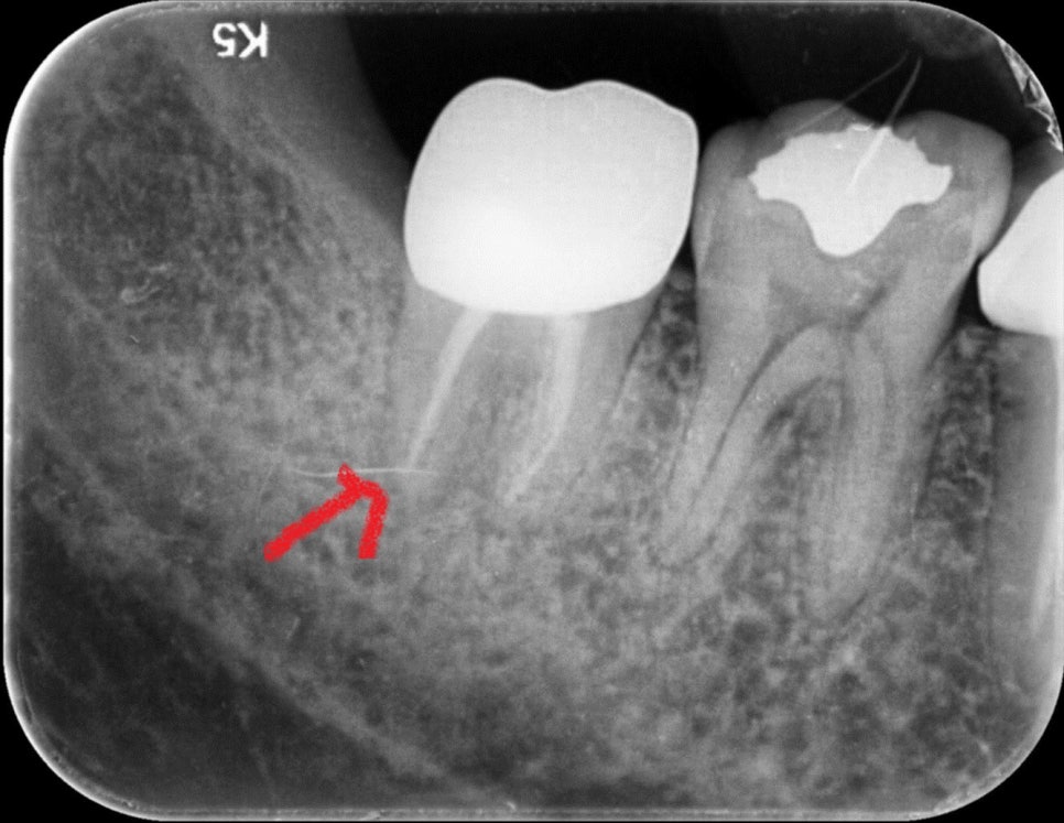 [신논현 치과] 임플란트 대신 치아재식(아름드리치과) 관련 이미지 4