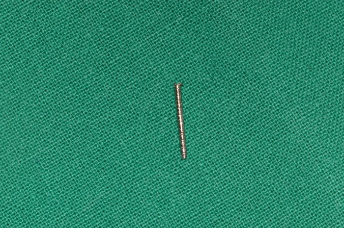 재신경치료_다시하는 신경치료 _기둥(post) 제거하기 관련 이미지 5