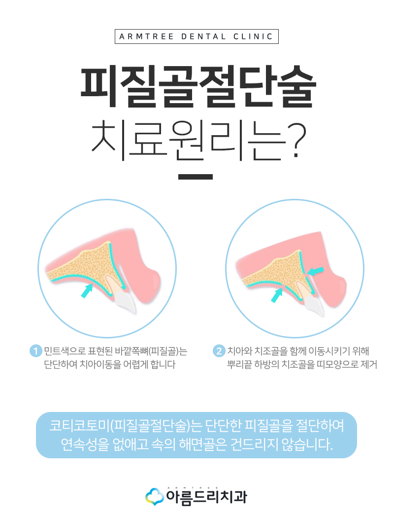 급속치아교정 코티코토미 피질골절단술 후기 관련 이미지 8