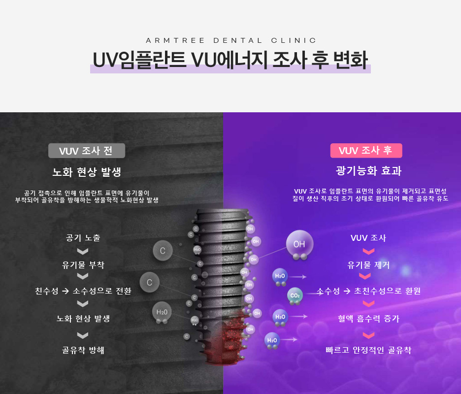 해외 이민 전 임플란트 치과 진료일기(feat. UV임플란트) 관련 이미지 2